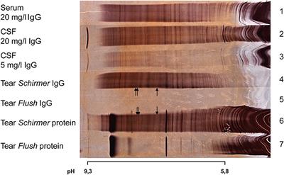 Investigation of Oligoclonal IgG Bands in Tear Fluid of Multiple Sclerosis Patients